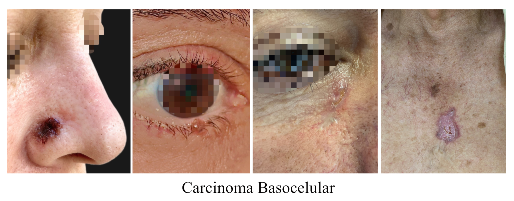 Carcinoma Basocelular Drhenriquemarques Br