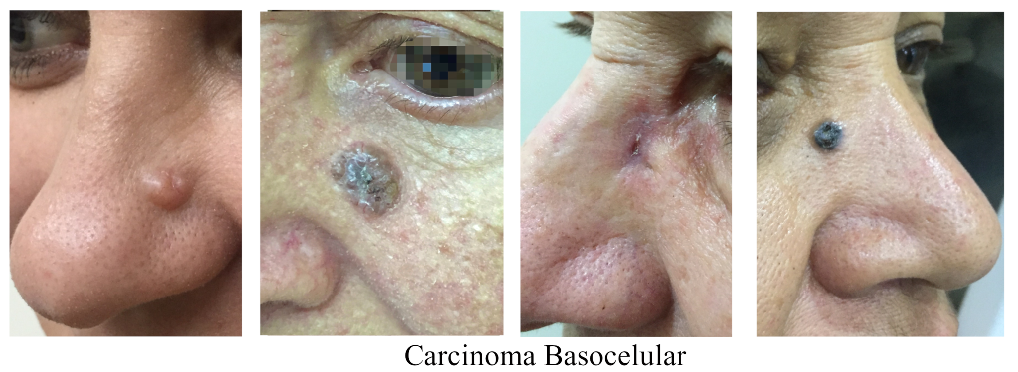 Carcinoma Basocelular Tratamento De Câncer De Pele 