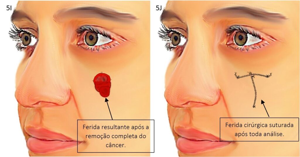 Cirurgia micrográfica de Mohs 