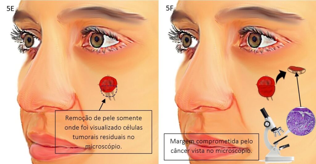 Cirurgia micrográfica de Mohs 