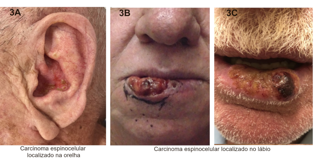 Carcinoma Espinocelular orelha