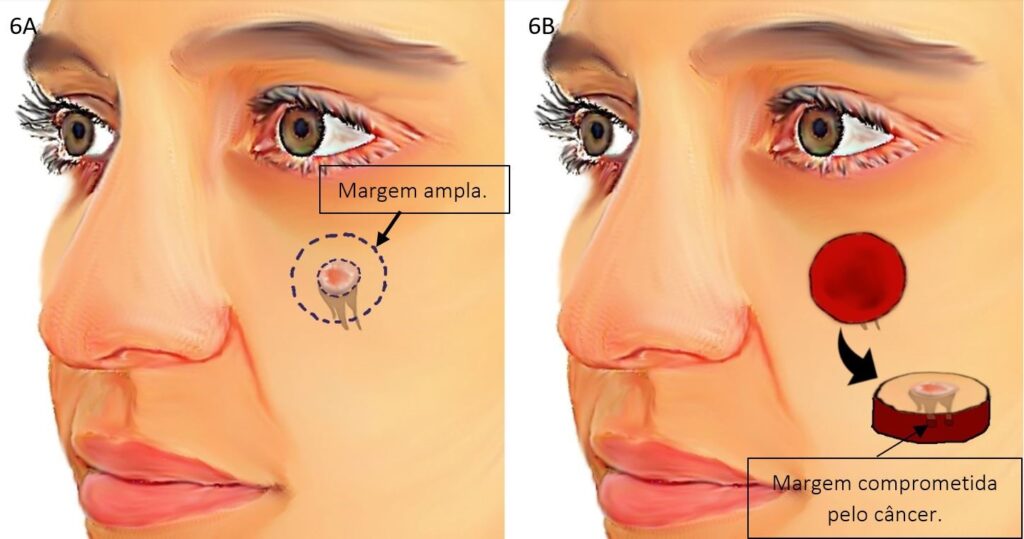 Cirurgia com margens convencionais 