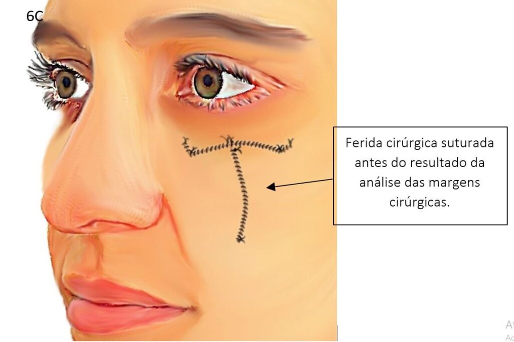 Cirurgia com margens convencionais 