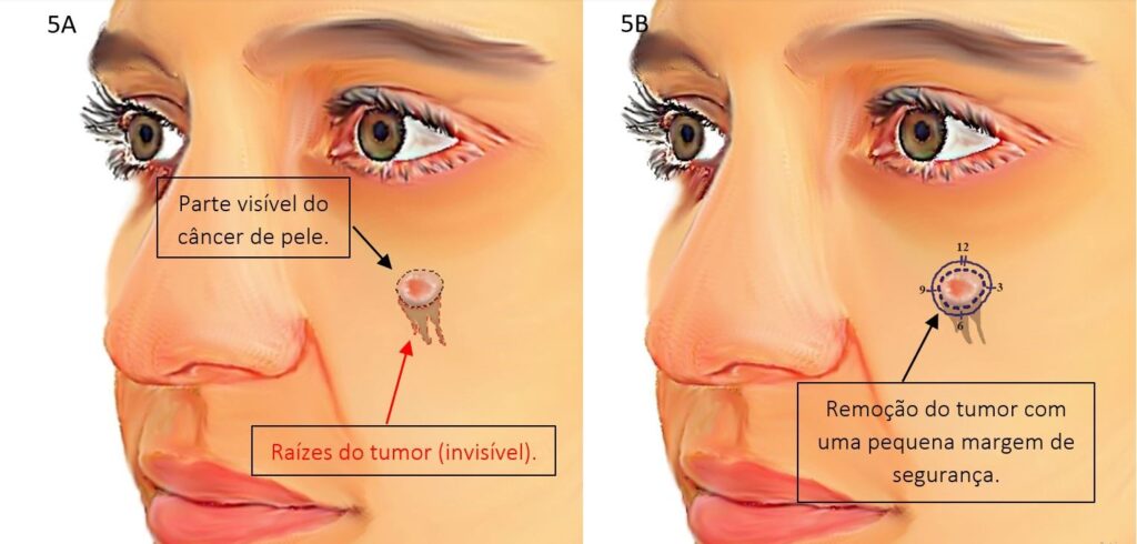 Cirurgia micrográfica de Mohs 