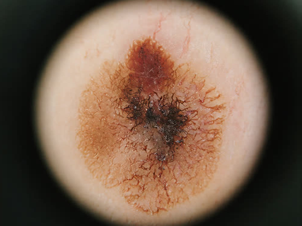 Lesão de pele vista pelo dermatoscópio